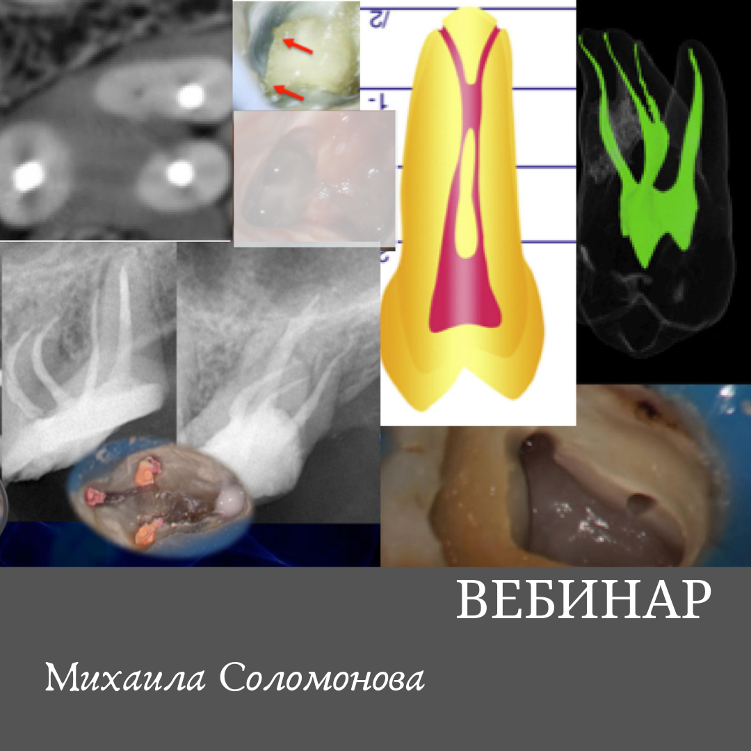 MB2 в жизни эндодонтиста - EndoSchool